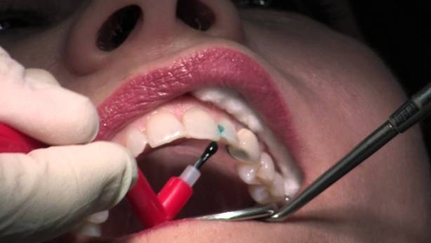 How Long Does it Take to Fill a Cavity 99Science